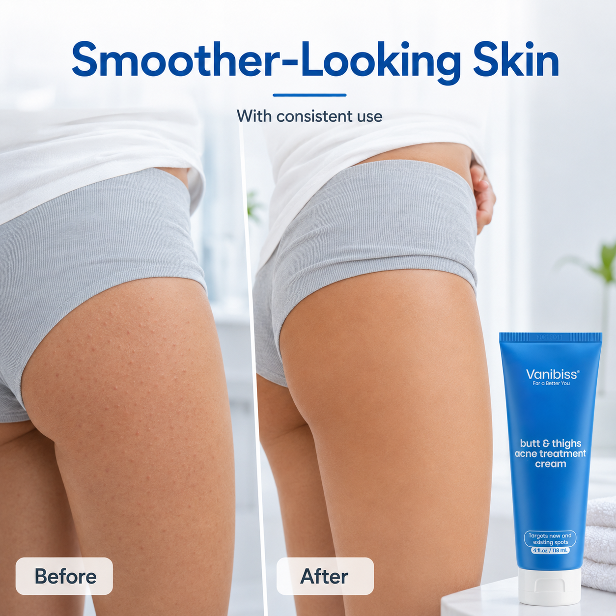 Butt & Thighs Acne Treatment Cream